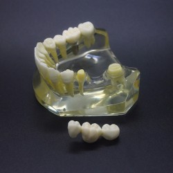 Onderzoek naar tandheelkundige implantaten Typodont-model Onderkaak Crown Bridge 2010