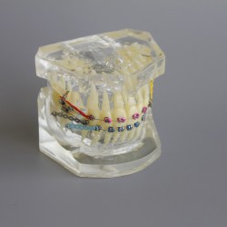 Tandheelkundige Orthodontische demonstratie praktijkmodel met metalen beugel Archwire