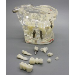 Dental Analyse van implantaatonderzoek Demonstration Teeth Disease Model met Restoration