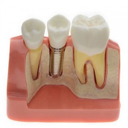Analysemodel voor tandheelkundig implantaat M2017