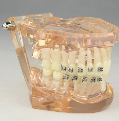 Tandheelkundig Orthodontisch model met keramische beugels M3009