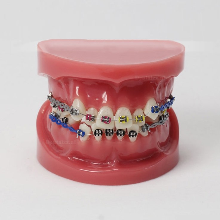 Tandheelkundige tanden Malocclusie Correct met tandenbeugel Standaardmodel M3005