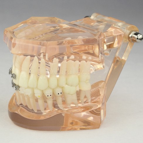 Tandheelkundig Orthodontisch model met keramische beugels M3009