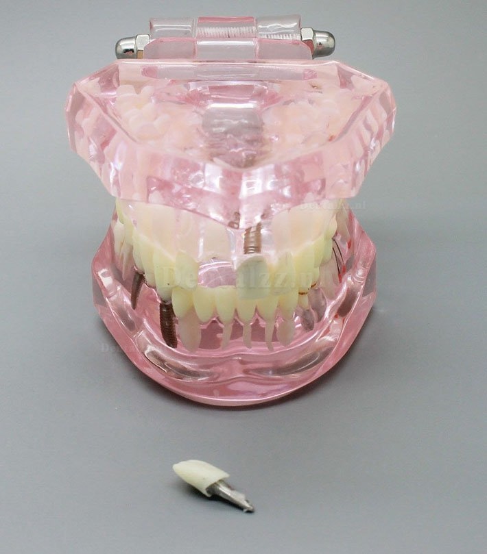Tandheelkundig Analyse van implantaatonderzoek Demonstratietanden Model met restauratie ROZE