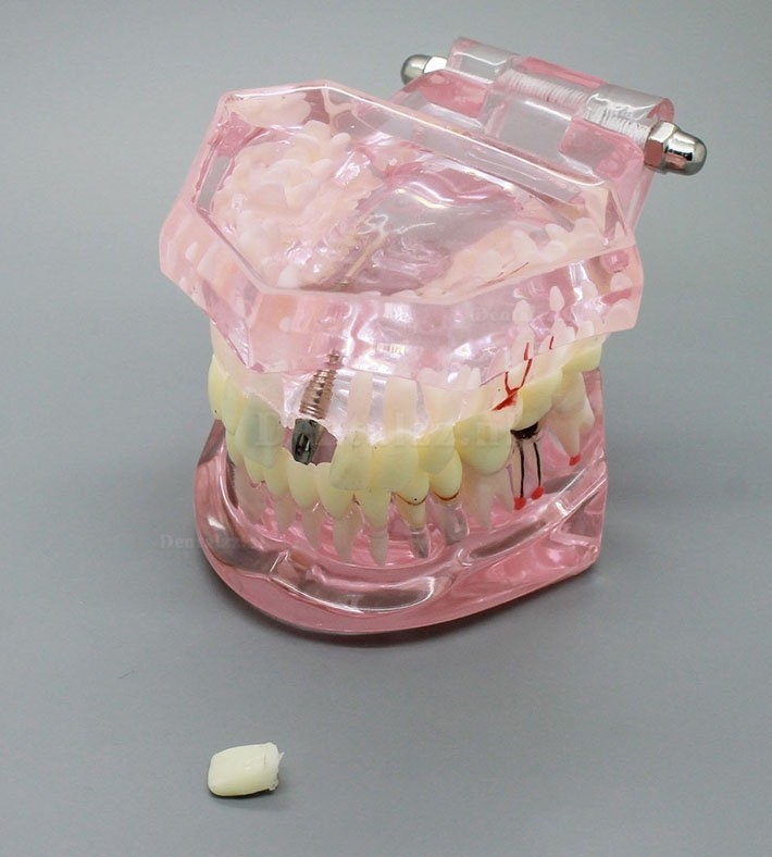 Tandheelkundig Analyse van implantaatonderzoek Demonstratietanden Model met restauratie ROZE
