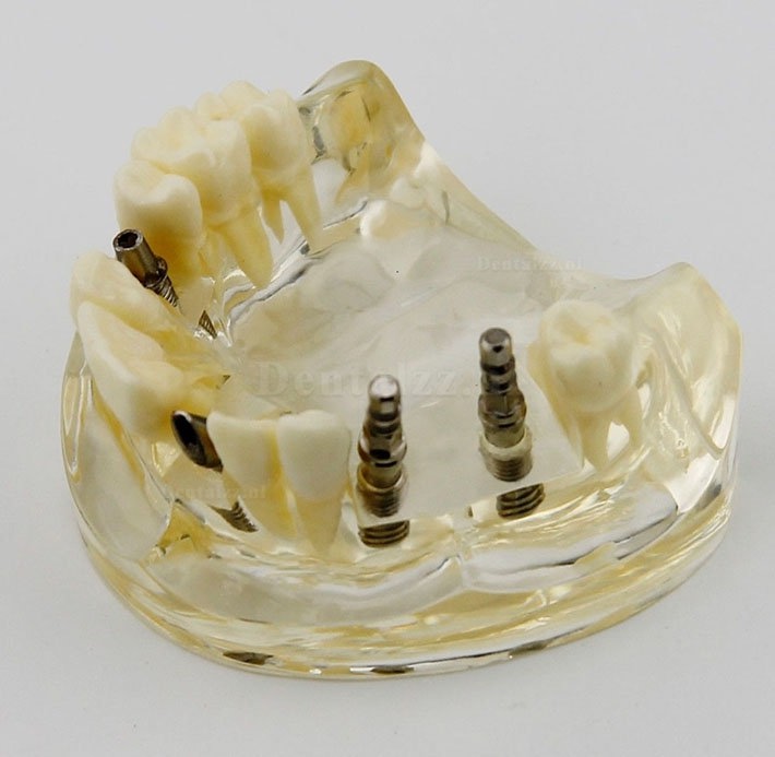 Tandheelkundige bovenkaak implantaatchirurgie studie Dem Model 2005
