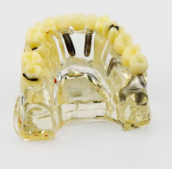 Tandheelkundig implantaat Typodont-model met brug en cariës Bovenkaaktandenmodel