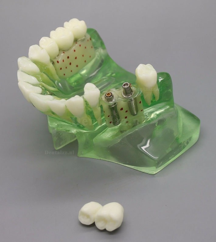 Tandheelkundig model# 2015 01 - Implantaatmodel voor de bovenkaak met sinus